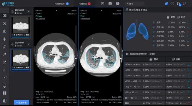 您的CT片，可能是AI医生来读的